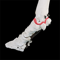 中足趾節関節の写真（3-3）サムネイル