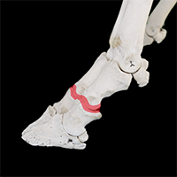 近位趾節間関節の写真（2-3）サムネイル