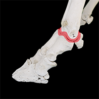 中足趾節関節の写真（2-3）サムネイル